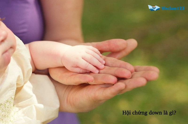 hội chứng down hội chứng down