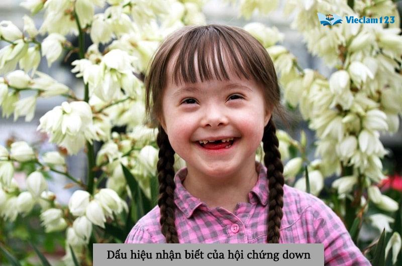 hội chứng down hội chứng down