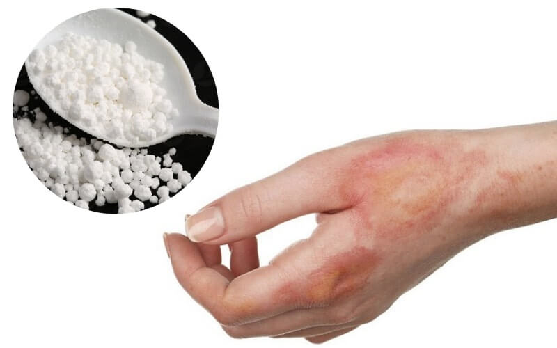 Tiếp xúc trực tiếp với clorua vôi có thể gây bỏng da