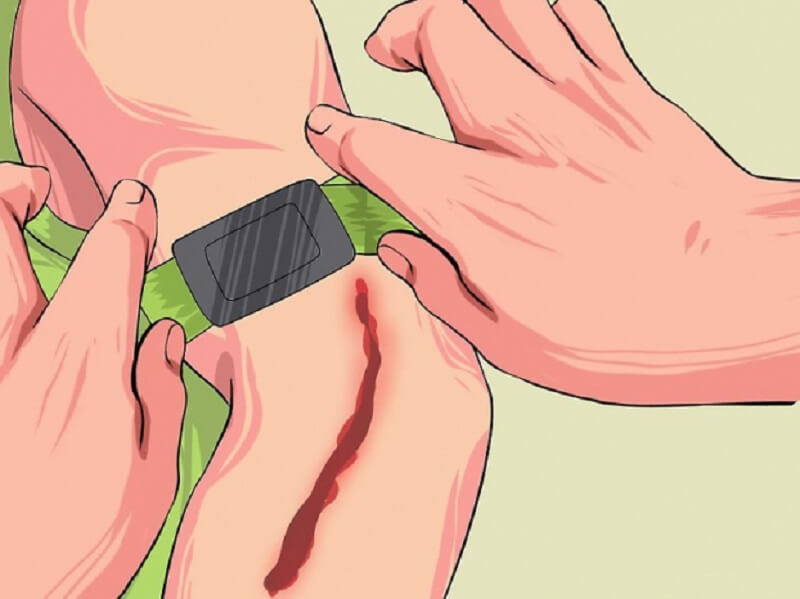 Buộc garô là phương pháp sơ cứu cầm máu tạm thời