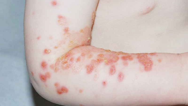 Chữa một số bệnh liên quan đến da