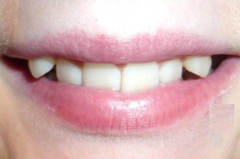 Con trai có răng khểnh 2 bên không tốt