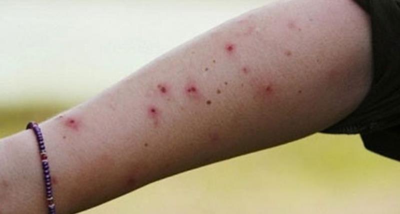 Làm dịu các vết do côn trùng và sâu bọ cắn