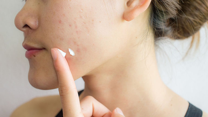 Công dụng kỳ diệu của Azelaic Acid