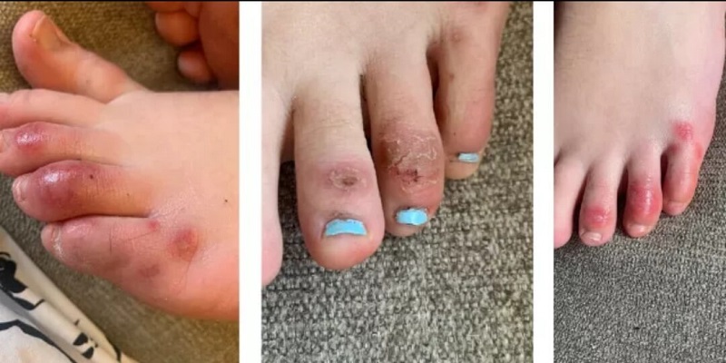 Dấu hiệu nhận biết cước chân