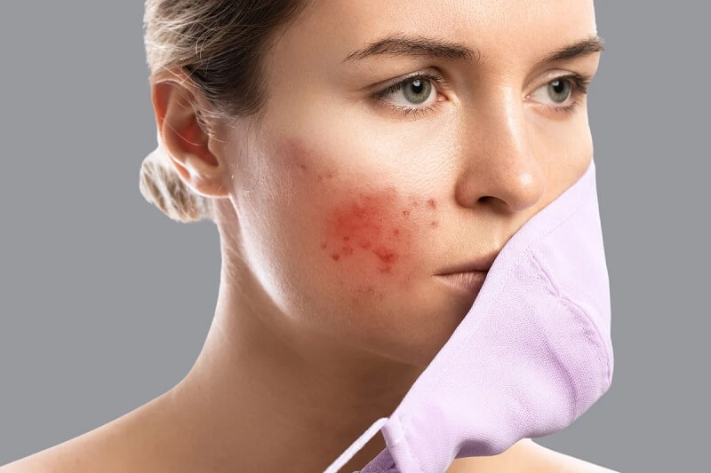 Da bị break out sẽ bị mọc mụn không kiểm soát