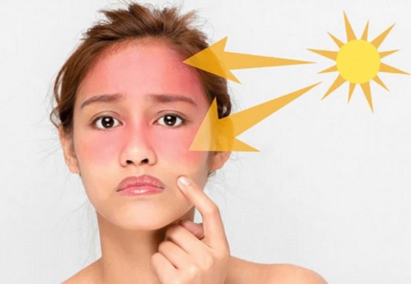 Nguyên nhân khiến làn da bị cháy nắng