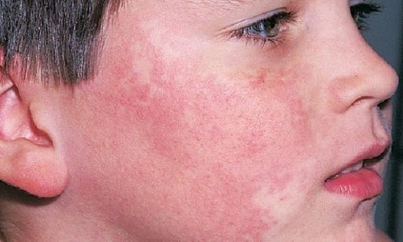 Ngăn ngừa tình trạng da bị ửng đỏ