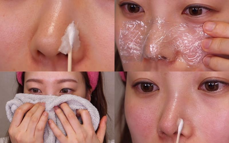 Sáp nẻ trị mụn đầu đen hiệu quả