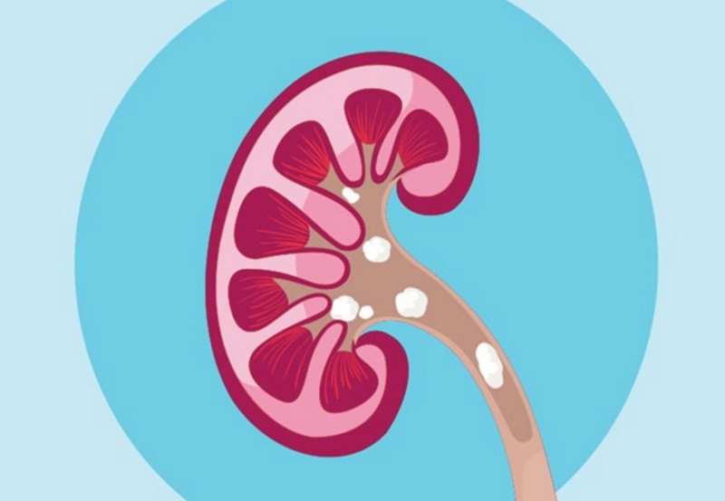 Tốt cho người sỏi thận