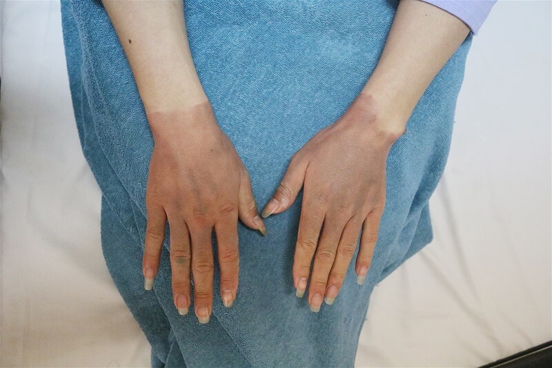 Dấu hiệu, triệu chứng của phỏng lạnh