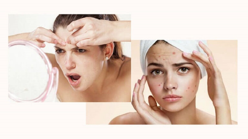 Một số lưu ý khi bị mụn