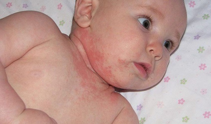 Điều trị rôm sảy