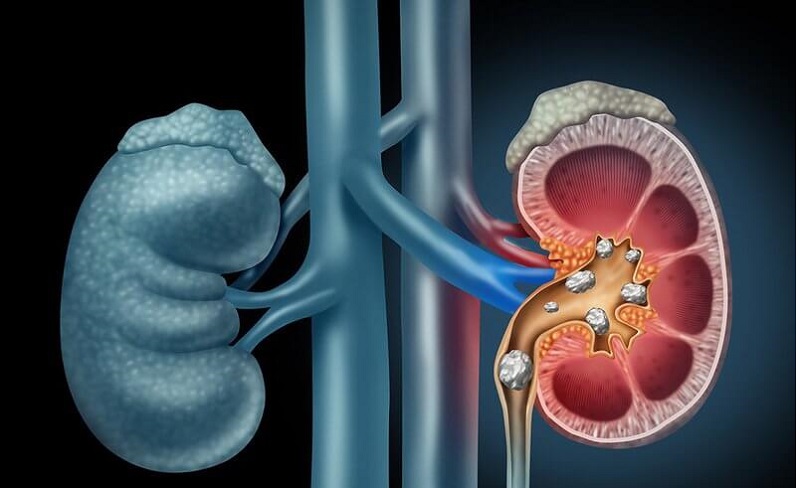 Hạn chế mắc sỏi thận 