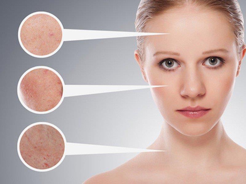 Glycerin hỗ trợ làm sạch và điều trị mụn trứng cá cho da