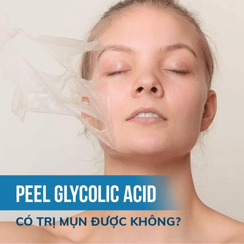 Glycolic acid hỗ trợ trị mụn