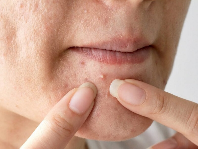 Gom cồi mụn giúp việc điều trị trở nên nhanh chóng