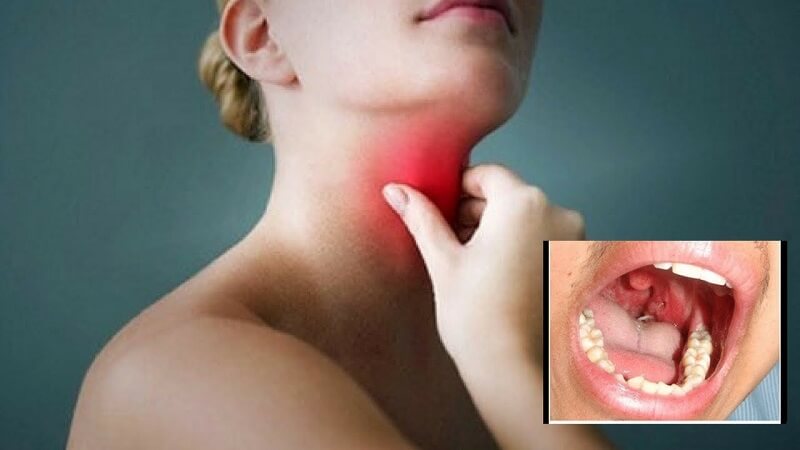 Hóc xương cá dù nhẹ cũng để lại cảm giác vô cùng khó chịu