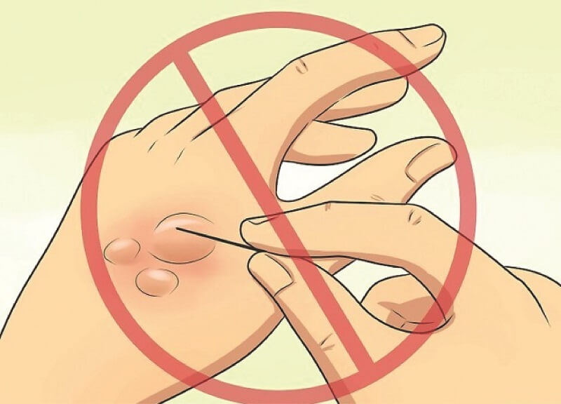 Cách sơ cứu nhanh tình trạng phỏng lanh