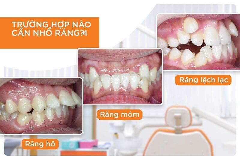 Cũng có những trường hợp cần thiết để nhổ răng số 4