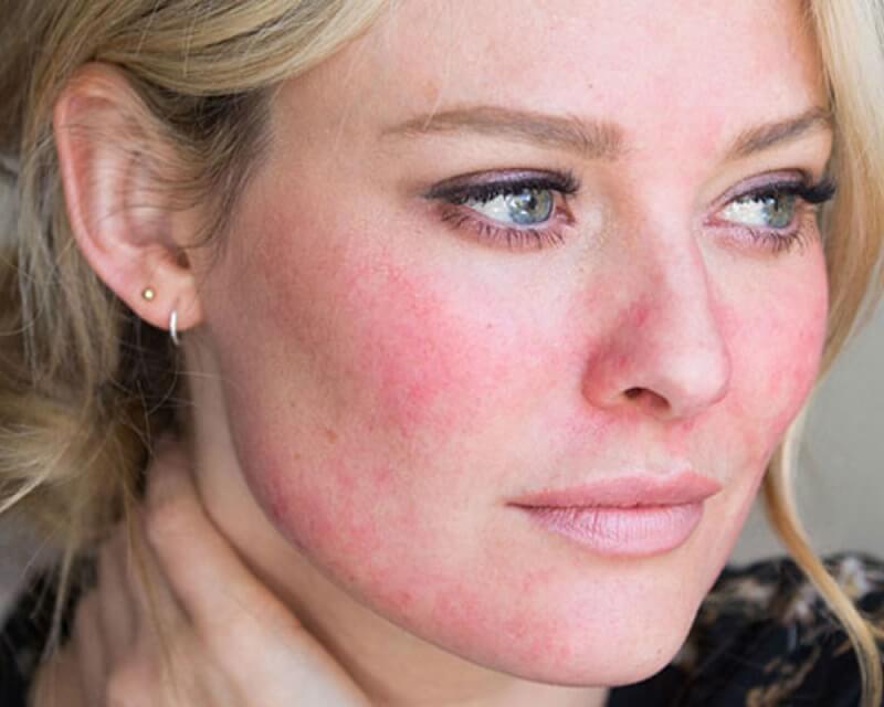 Đeo khẩu trang lâu có thể gây kích ứng da mặt