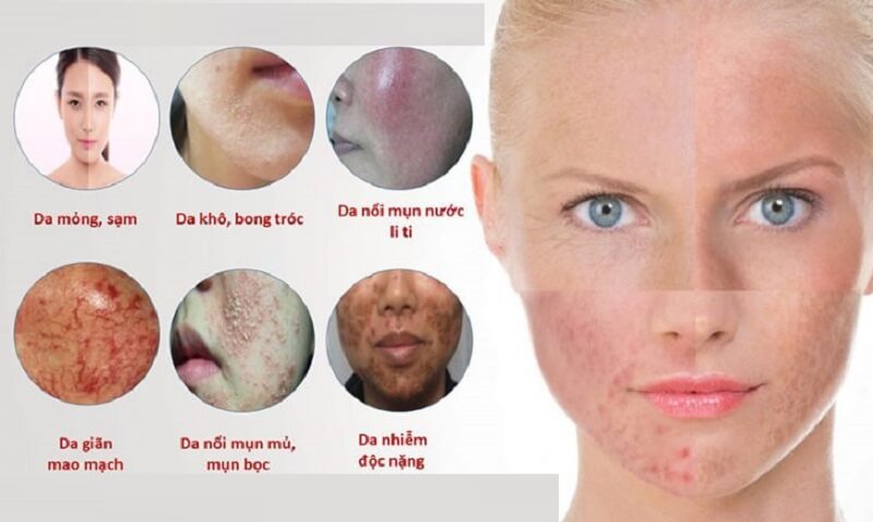 Lạm dụng Corticoid khiến da yếu ớt hơn và dễ bị tổn thương hơn