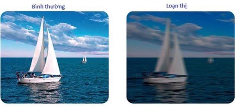 Loạn thị cận xảy ra khi người bệnh bị cận thị và loạn thị