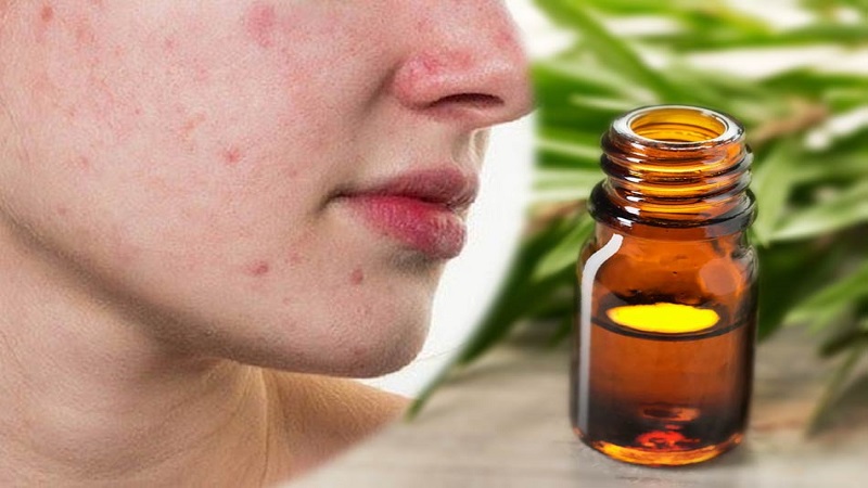 Làm mỹ phẩm trị mụn