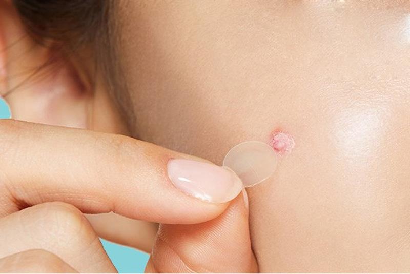Lưu ý cần biết khi dùng miếng dán mụn