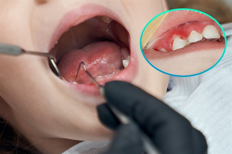 Viêm nướu răng hình thành do mảng bám vi khuẩn