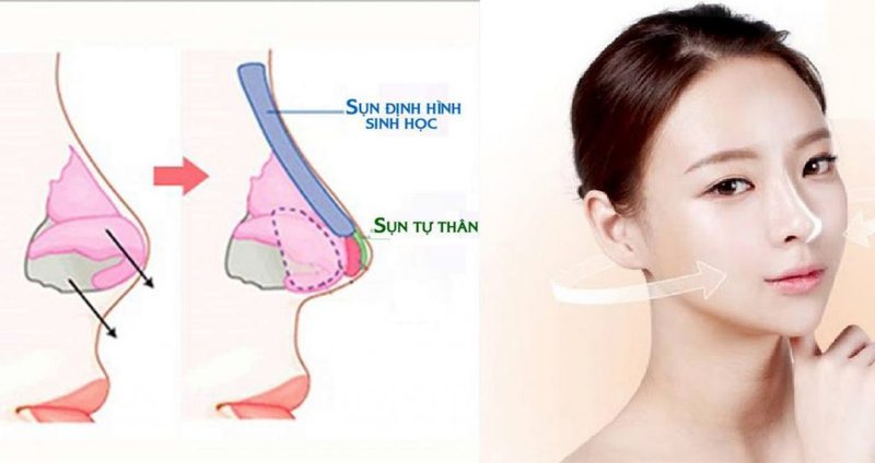 Không cần phẫu thuật thẩm mỹ