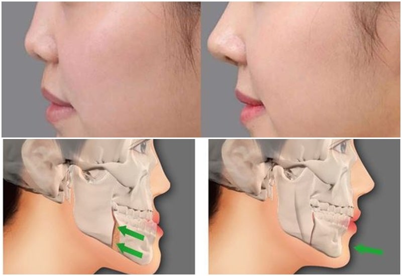 Cách luyện tập mewing