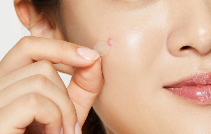 Miếng dán mụn giúp vết thương mau lành và che phủ vết mụn rất tốt