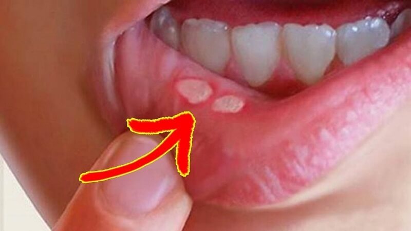 Bệnh nhiệt miệng xảy ra khi cơ thể thiếu chất dinh dưỡng