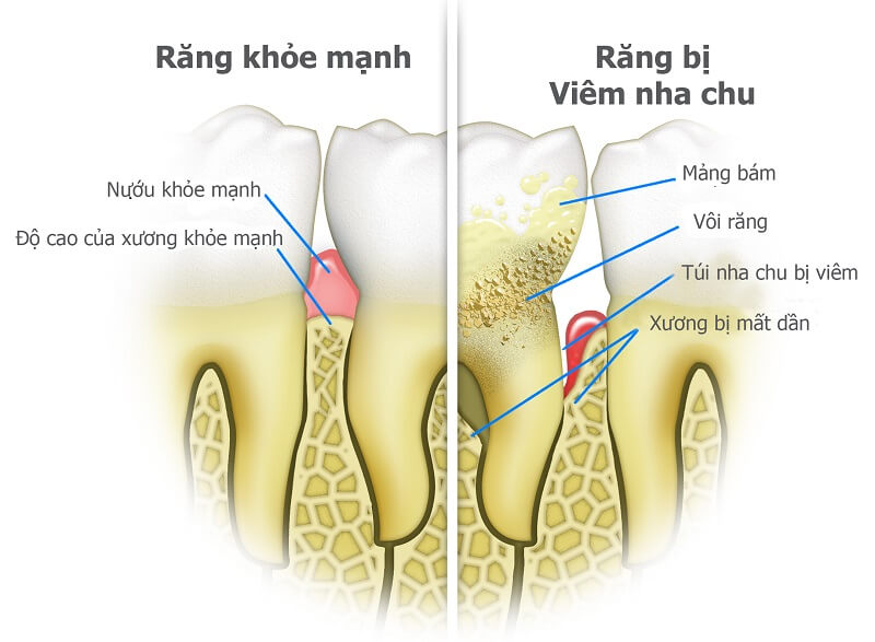 Cách nhận biết bệnh viêm nướu răng