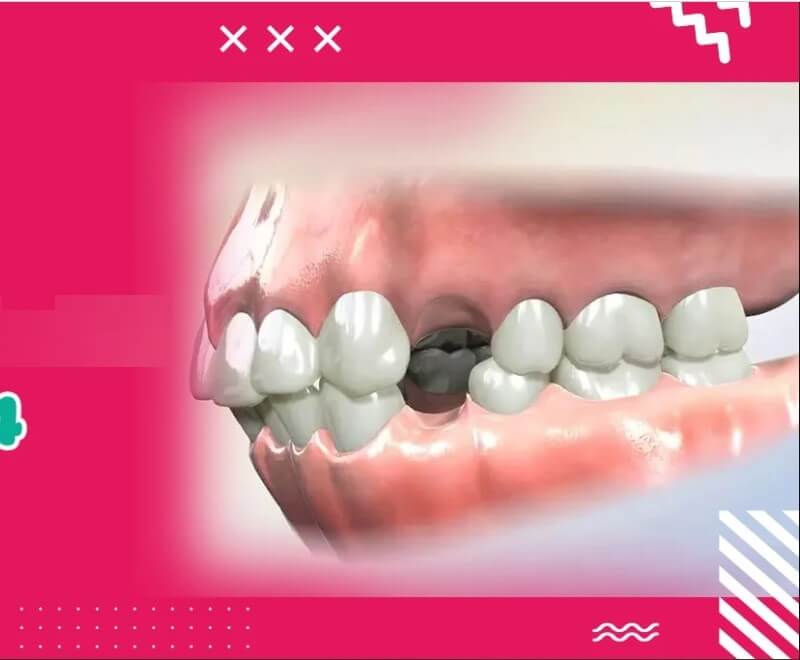 Nhổ răng số 4 ảnh hưởng lớn tới hàm