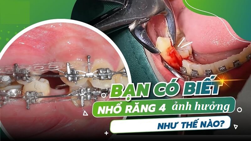 Nhổ răng số 4 ảnh hưởng như thế nào
