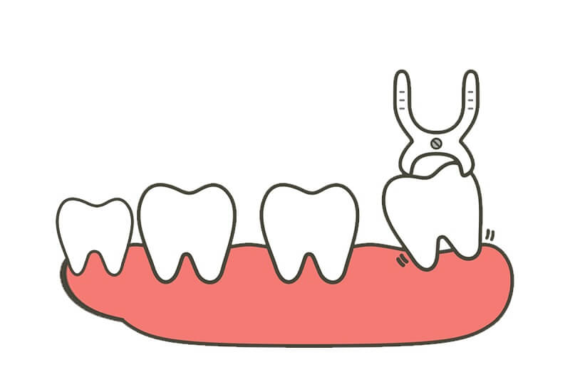 Nhổ răng số 4 có ảnh hưởng gì không