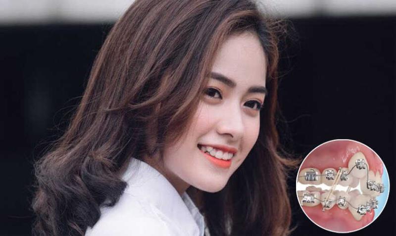 Nên niềng răng nếu răng khểnh xấu và xô lệch hàm