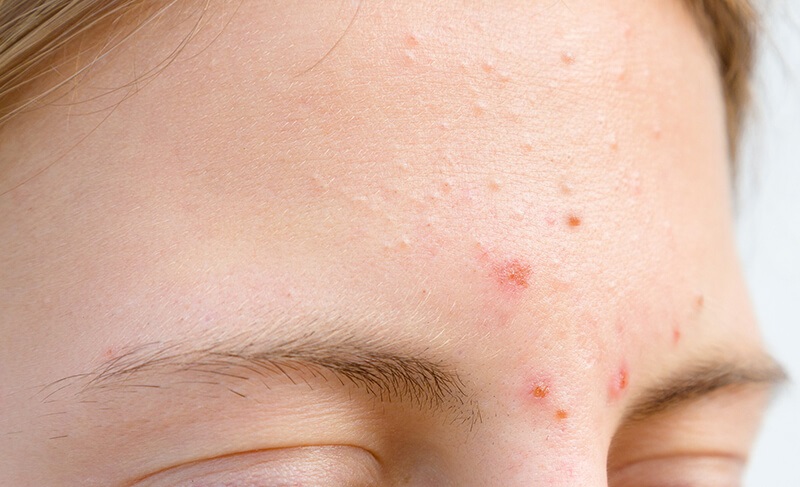 Do da bị dầu nhờn nhiều