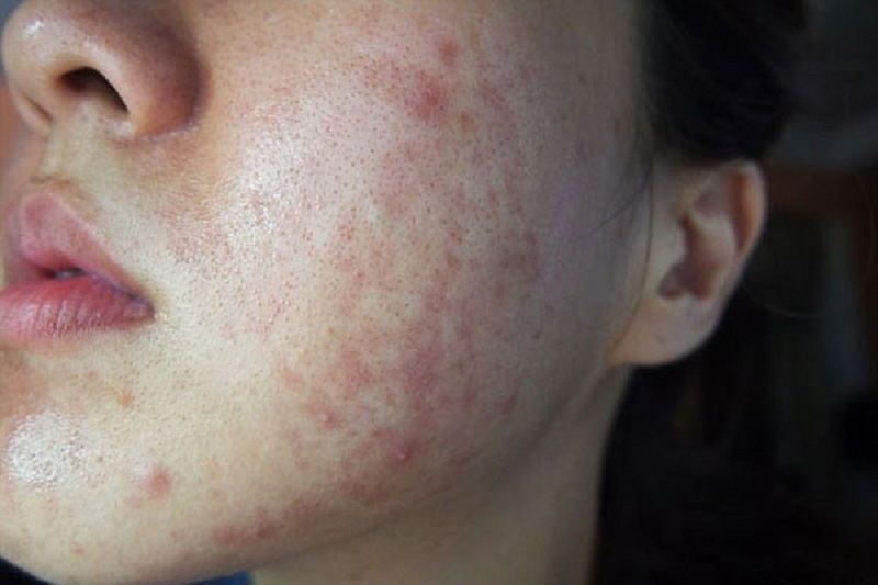 Khắp mặt bị nổi mụn