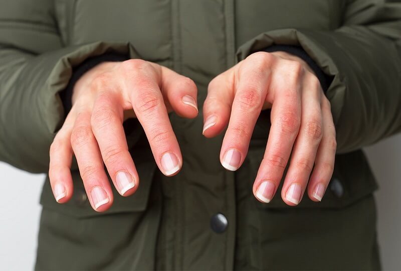 Phỏng lạnh là gì