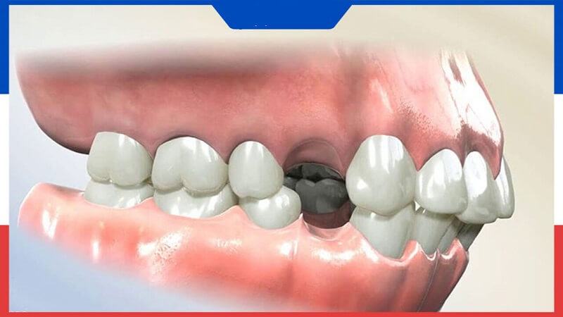 Răng số 4 bị nhổ đi sẽ ảnh hưởng khả năng nhai