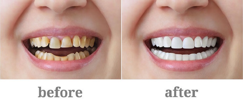 Trường hợp nên sử dụng răng sứ