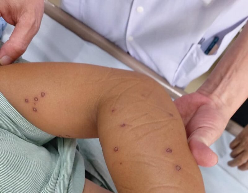 Nạn nhân bị ong vò vẽ có thể phải đi cấp cứu