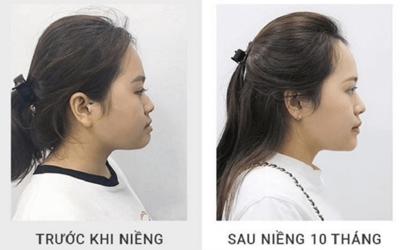 Thành quả sau niềng răng