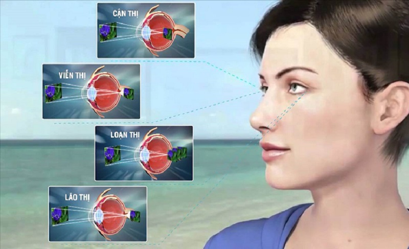 Là tình trạng rối loạn phổ biến ở mắt