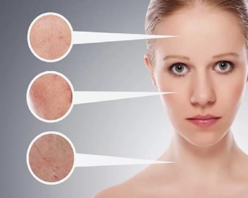 Sau khi tẩy da chết không thoa kem chống nắng và dưỡng ẩm