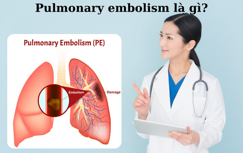 Đây là tình trạng tắc nghẽn mạch máu đột ngột ở phổi
