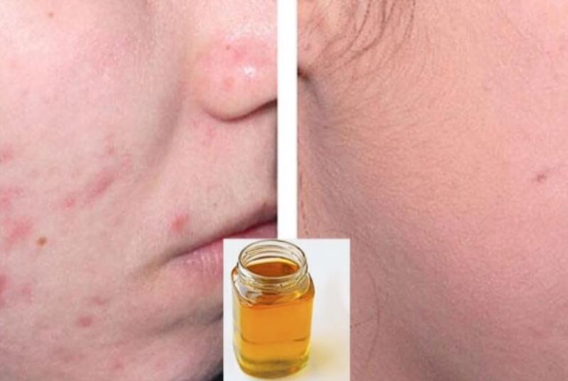 Điều trị mụn bằng mỡ trăn